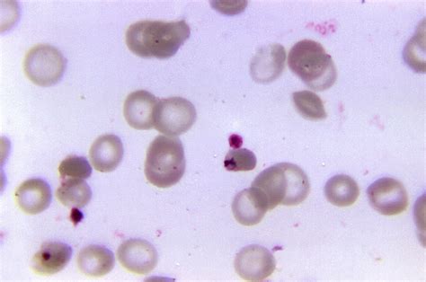  Falciparum Malaria Parasite: A Tiny Terror That Unleashes a Feverish Storm Within!